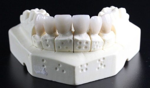 infectie implant dentar
